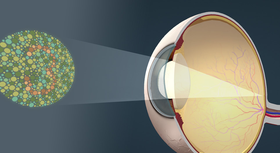 Colour vision deficiency