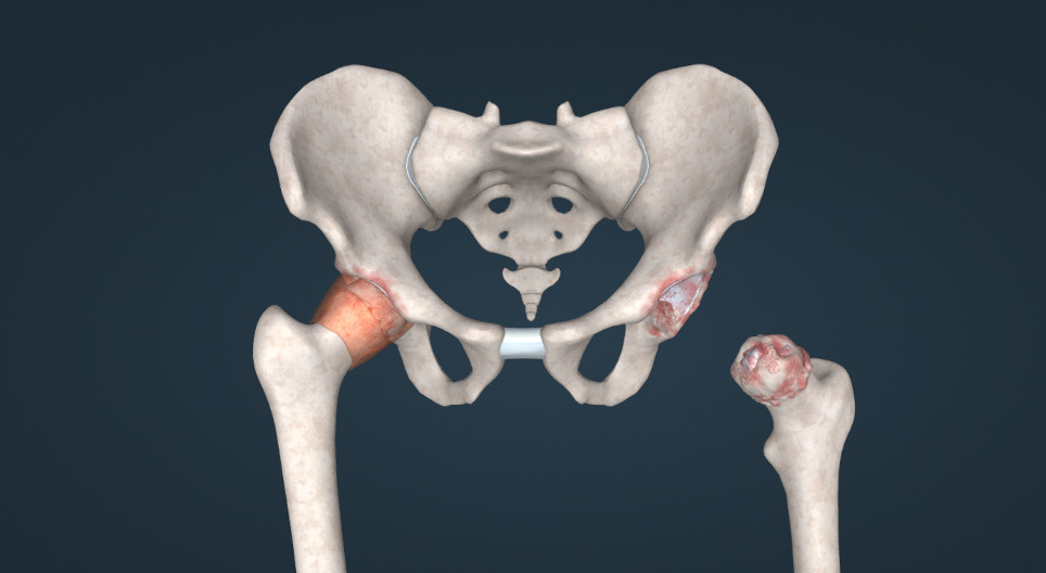 Osteoarthritis