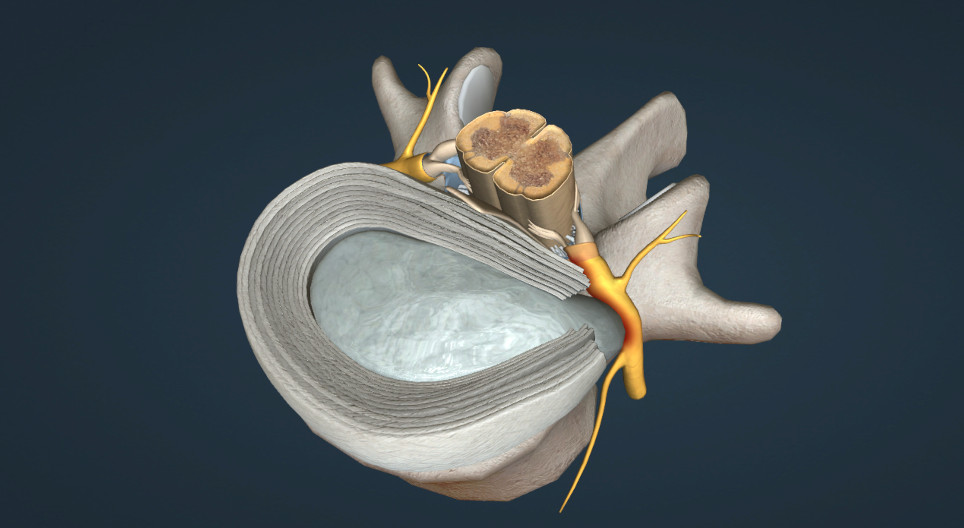 Spinal disc herniation