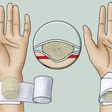 圧力包帯を適用