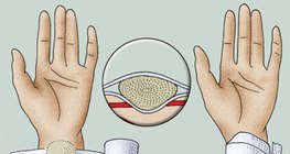 施加壓力的繃帶