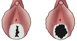 少女（左）和性生活活躍的女性的處女膜（右）