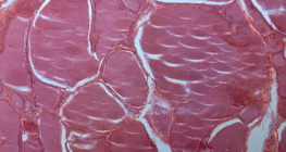 甲狀腺的一部分