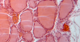 甲狀腺的一部分