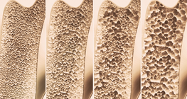 Osteoporosis