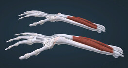 Caput ulnae syndrome