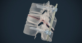 Surgical therapy for fractured vertebra