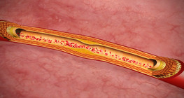 Atherosclerosis