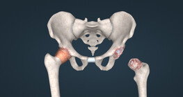 Osteoarthritis