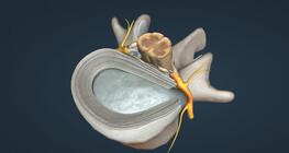 Spinal disc herniation