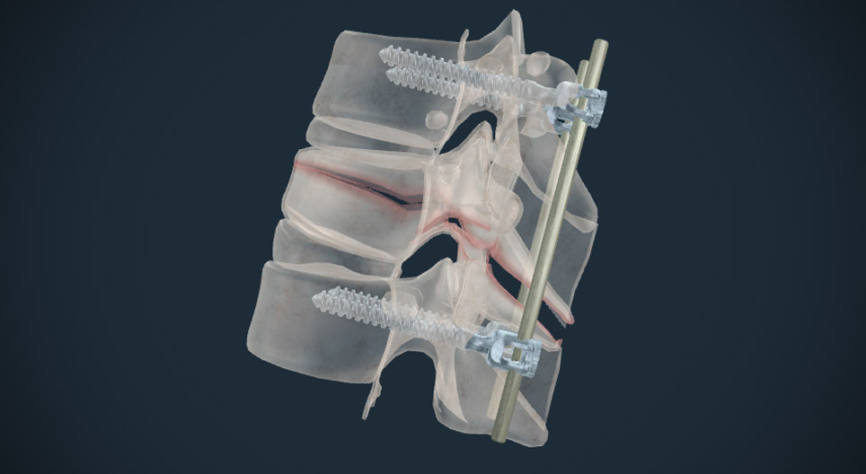 Surgical therapy for fractured vertebra